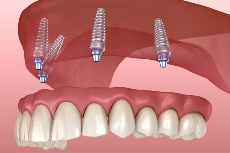 Trồng Răng Implant All On 4 Là Gì?