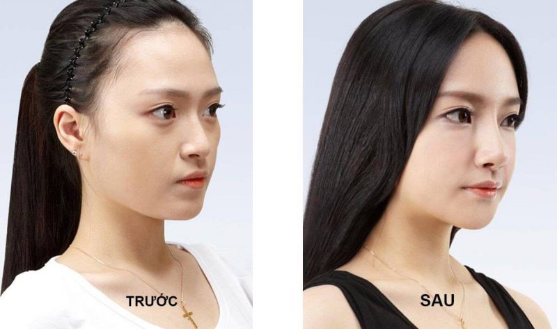 nâng mũi tại Hà Nội