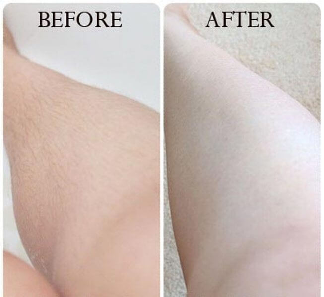 triệt lông tại hải phòng