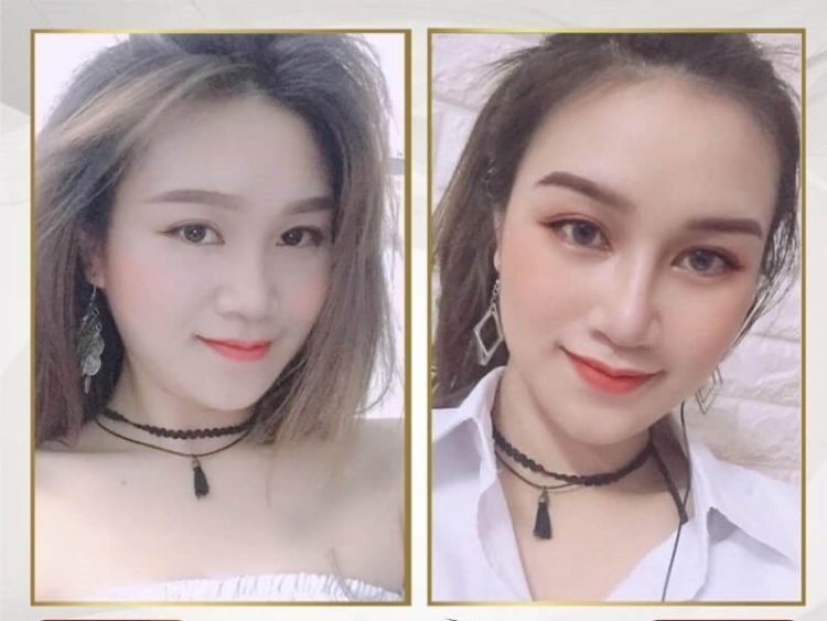nâng mũi tại Hà Nội
