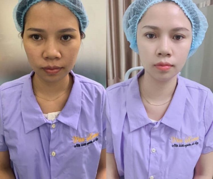 nâng mũi tại Hà Nội