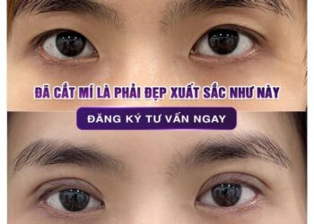 TOP 7 Địa Chỉ Cắt Mí Biên Hòa Siêu Chất Lượng Cho Chị Em