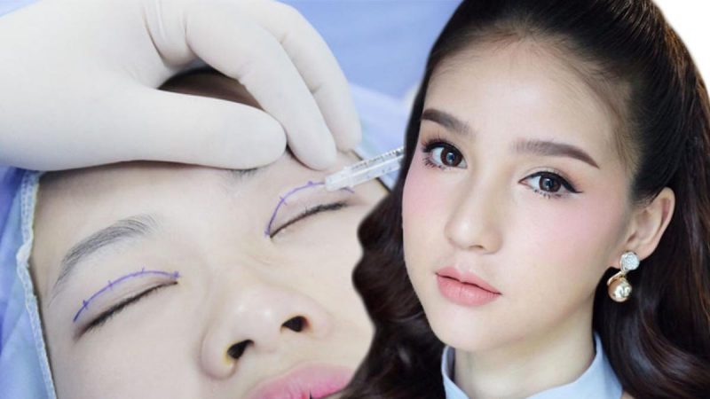 nhấn mí Cần Thơ
