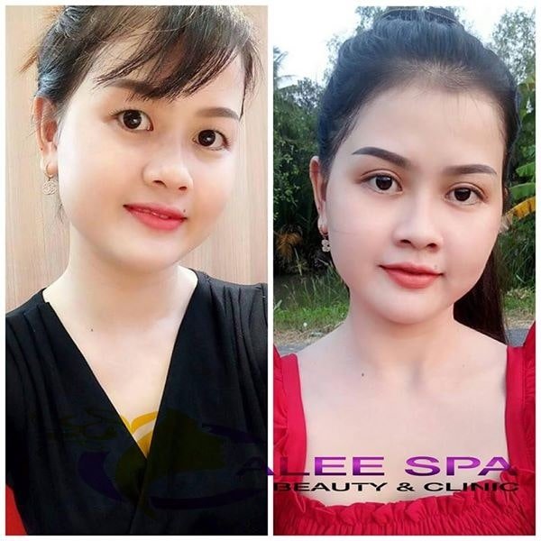 nhấn mí Cần Thơ