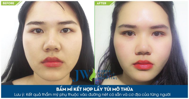 nhấn mí Cần Thơ