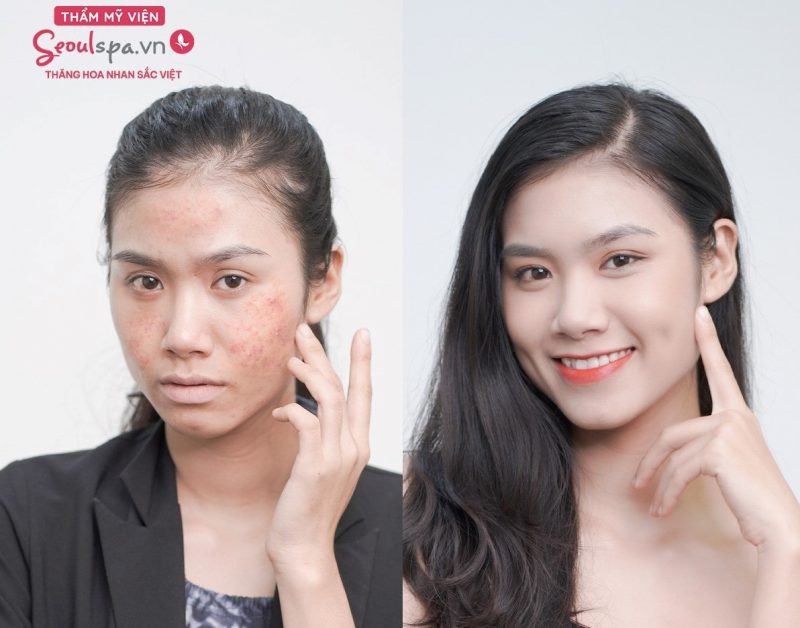 spa trị mụn đà nẵng spa trị mụn đà nẵng