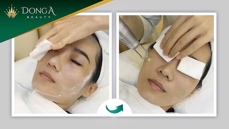 spa trị mụn đà nẵng spa trị mụn đà nẵng