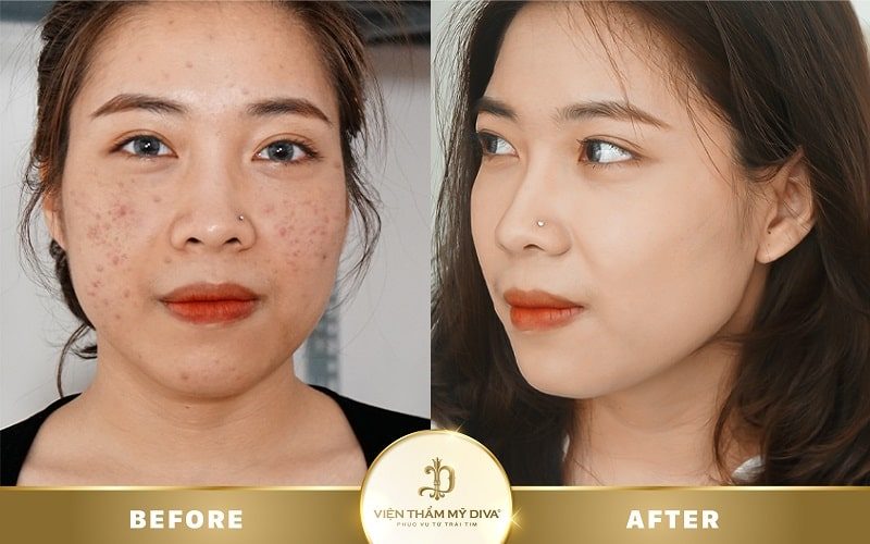 spa trị mụn đà nẵng Diva