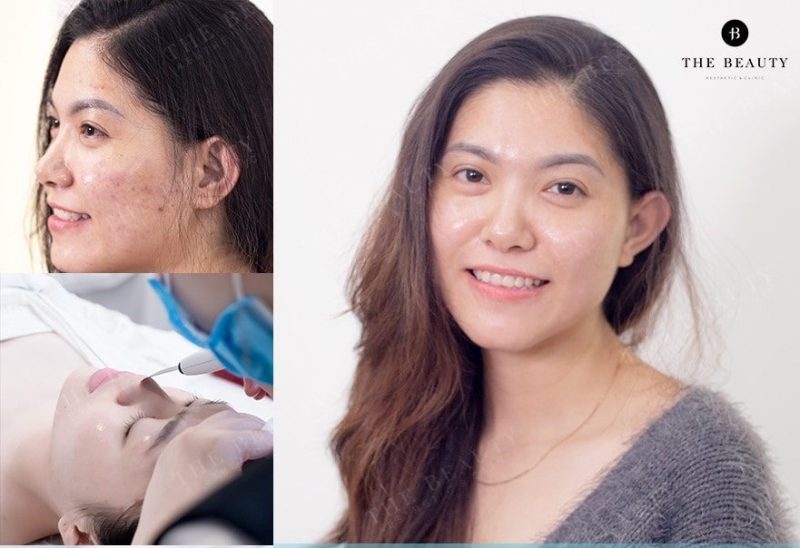 spa trị mụn đà nẵng spa trị mụn đà nẵng