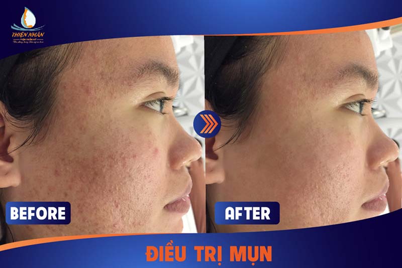 spa trị mụn đà nẵng spa trị mụn đà nẵng