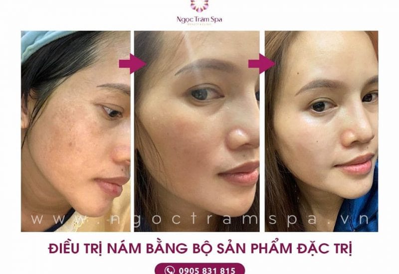 spa trị mụn đà nẵng Ngọc Trâm