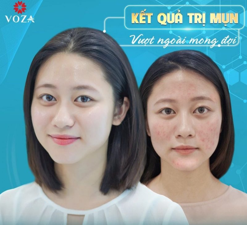 spa trị mụn đà nẵng Voza