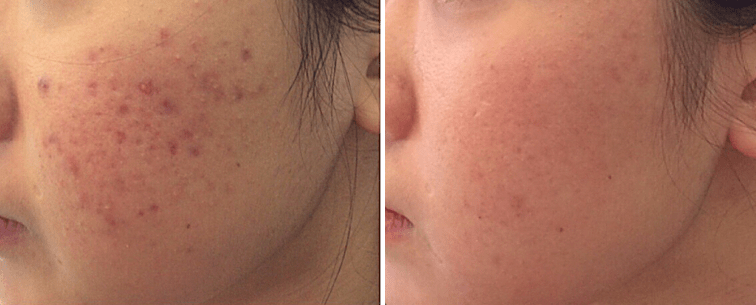spa trị mụn đà nẵng spa trị mụn đà nẵng