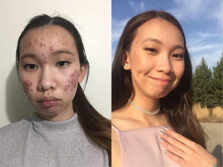 spa trị mụn đà nẵng spa trị mụn đà nẵng