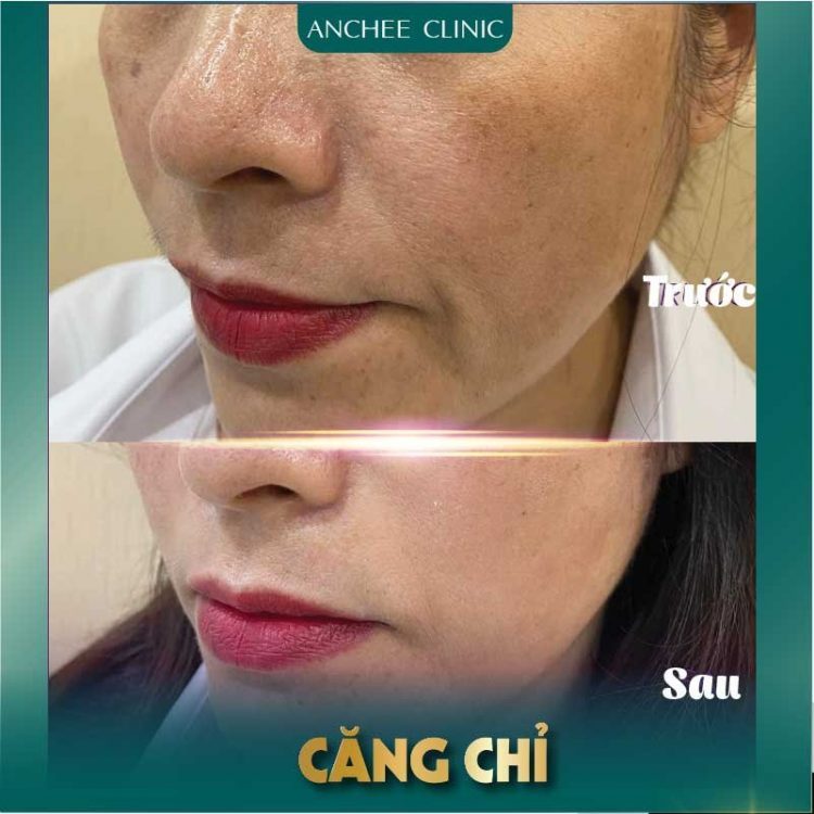 tiêm rãnh cười