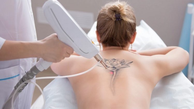xóa xăm bằng laser