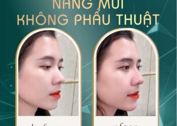 Tiêm Nâng Mũi Là Gì? Giá Tiêm Filler Mũi Bao Nhiêu Là Đủ?