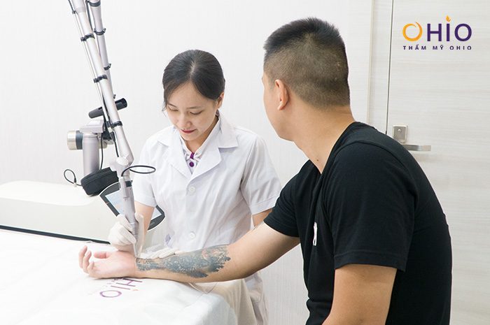 Xóa xăm Piconew 450 xóa hình xăm sạch mực, không sẹo