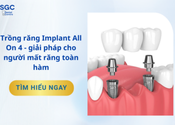 Trồng Răng Implant All On 4: Giải Pháp Mất Răng Toàn Hàm