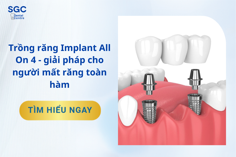 Trồng Răng Implant All On 4: Giải Pháp Mất Răng Toàn Hàm