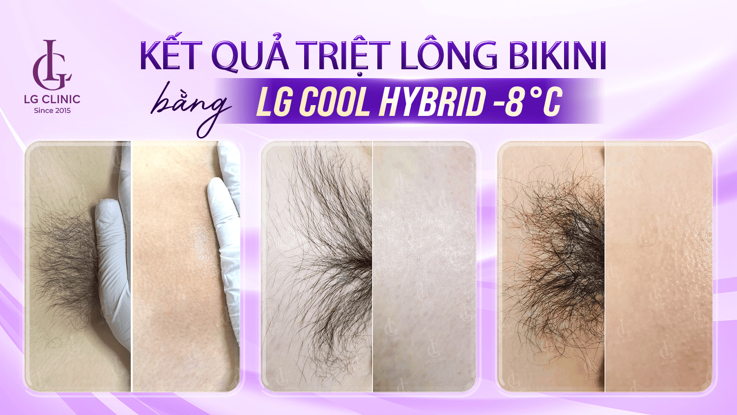 Hiệu quả triệt lông bikini LG Cool Hybrid thường thấy rõ sau chỉ sau 2-3 buổi